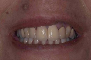 Veneers After