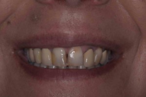 Veneers Before