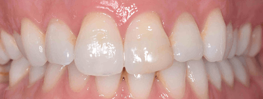 , Smilelign clear aligners in Bournemouth