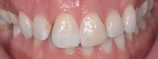 , Smilelign clear aligners in Bournemouth