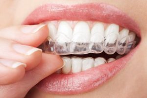 Fast Adult Braces, Fast Adult Braces in Bournemouth